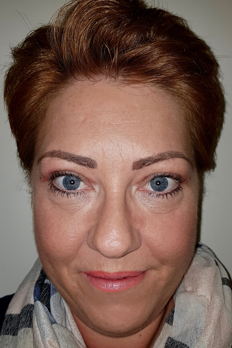 Before & After — after (post-operative)